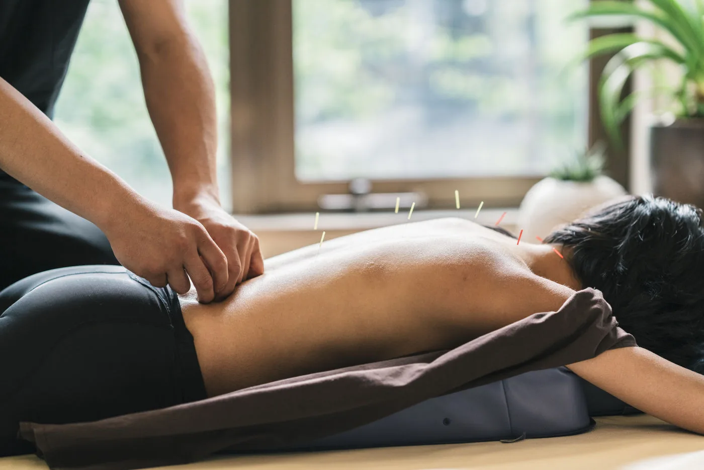 Practitioner positioning acupuncture needles during a back treatment