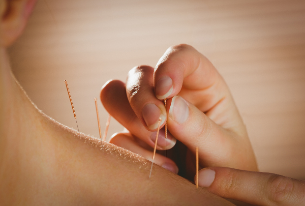 Acupuncture – Worthing