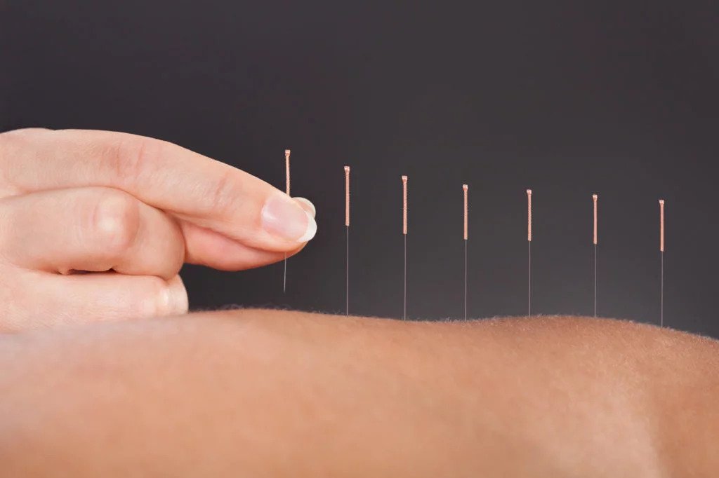 Acupuncture Tunbridge Wells